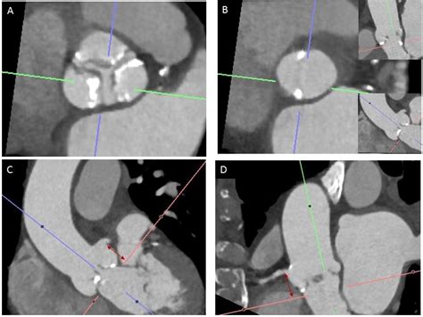 Use of CT in the Assessment of Valvular Function - American College of Cardiology