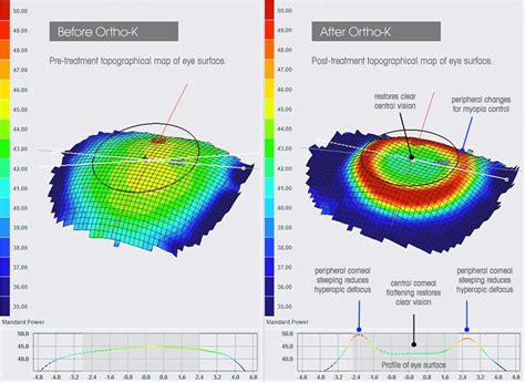 Ortho K vs Multifocal Soft Contact Lenses (Part 1) – My Kid's Vision ...