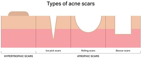 Rolling Acne Scars And The Effective Treatments To Eliminate Them ...