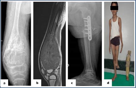 Biological Methods of Reconstruction After Excision of Extremity Osteosarcoma – Journal of Bone ...