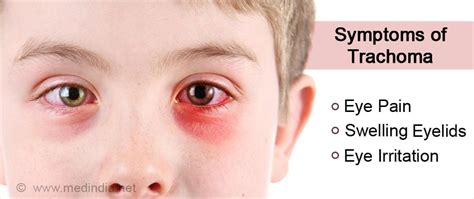 Trachoma - Causes, Symptoms, Complications, Diagnosis, Treatment, Prevention & Prognosis