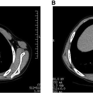 Chest CT of the patient. (A) Preoperative examination before... | Download Scientific Diagram