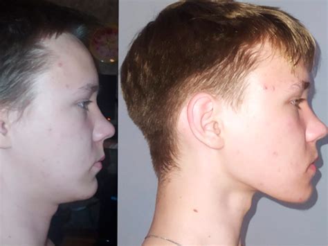 Mewing Before & After Results: 70+ Crazy Transformations