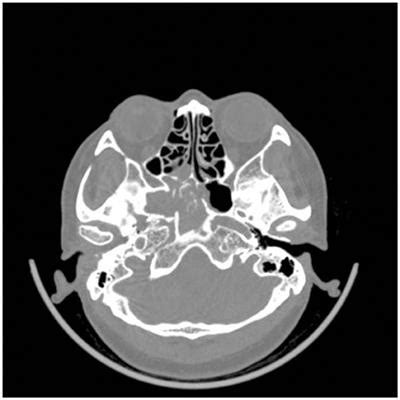 Frontiers | Headache Secondary to Isolated Sphenoid Sinus Fungus Ball ...