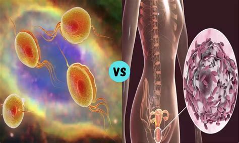 Trichomonas and Gardnerella 07 effective difference