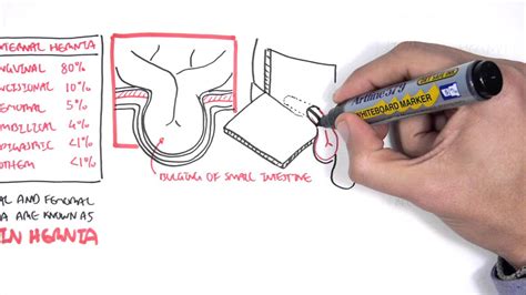 Direct Inguinal Hernia Anatomy