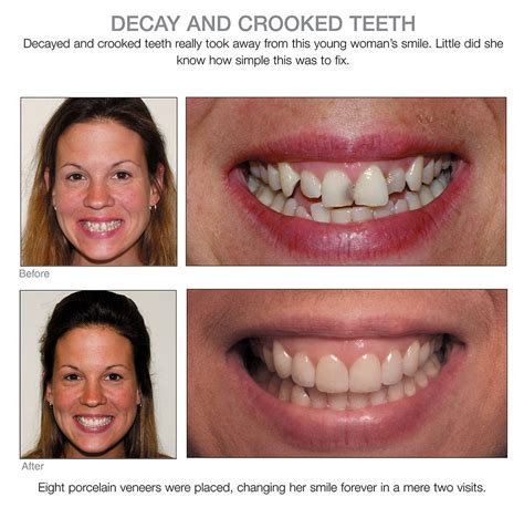 Crooked teeth gone | Estetica dental, Protesis dental fija, Dental