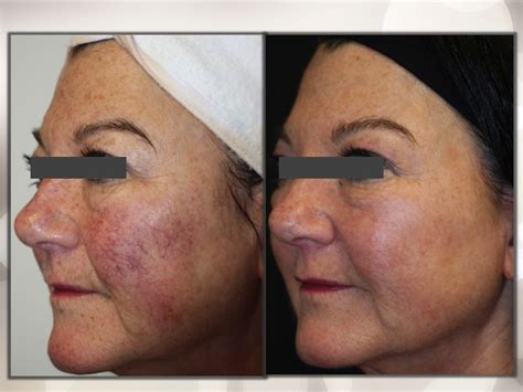 KTP Laser – UCosmetic