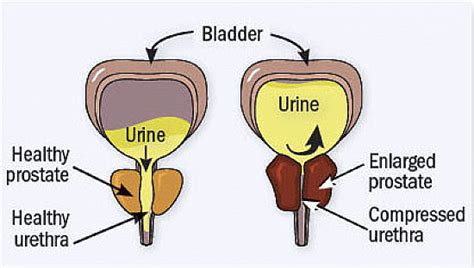 10 benign prostatic hyperplasia (BPH) facts - Chronic Kidney Disease Explained