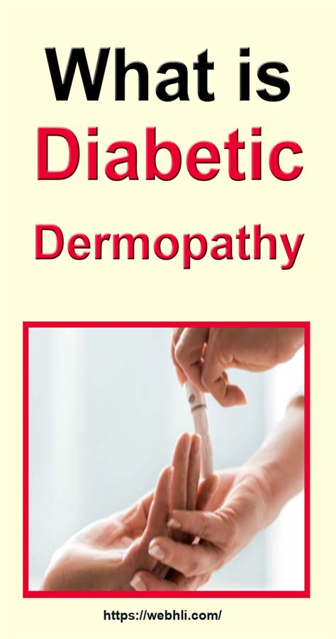 What is Diabetic Dermopathy? | Healthy Lifestyle