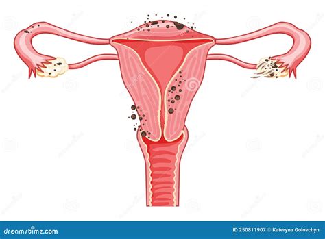 Endometriosis Stages Female Reproductive System Pain Uterus. Front View Stock Vector ...