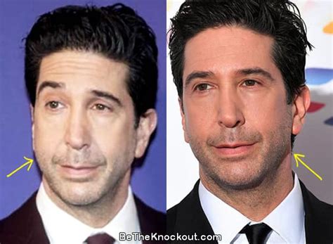 David Schwimmer Plastic Surgery Comparison Photos