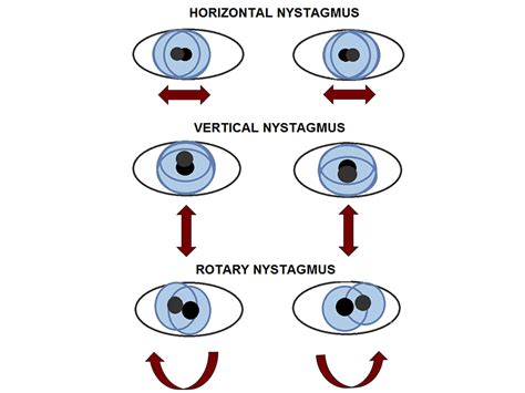 nystagmus-types - Smith-Magenis Syndrome Foundation UK