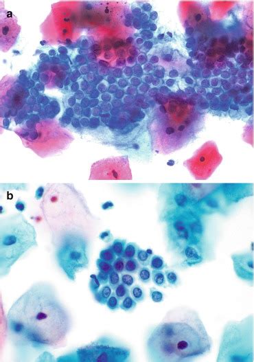 Gynecologic Cytology | Basicmedical Key