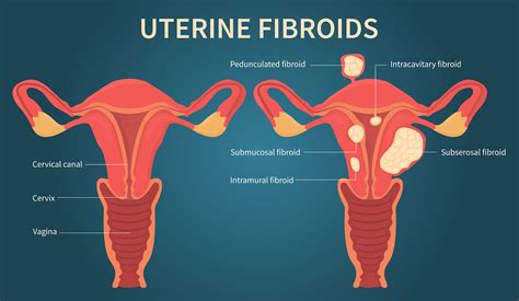 Uterine fibroids - UF Health