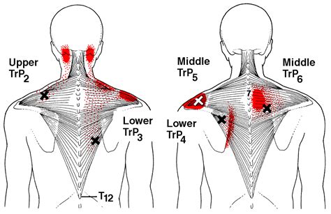 Burning Pain Between Your Spine and Shoulder Blade | SIMPLE BACK PAIN ...