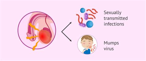 Orchitis and its causes