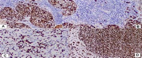 Immunohistochemistry from uterine carcinosarcoma-A) Positive diffuse ...