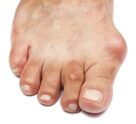 Gout: Symptoms, Pictures, Treatment, and More