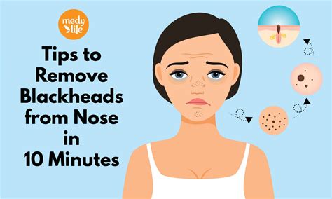 Tips to Remove Blackheads from Nose in 10 Minutes - Medy Life