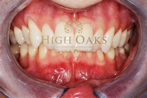 High Oaks Dental Practice – Inman Aligner Gallery