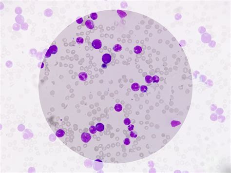 What do Leukocytes in Urine mean?