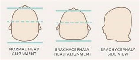 Assessment and evaluation for baby's flat head plagiocephaly