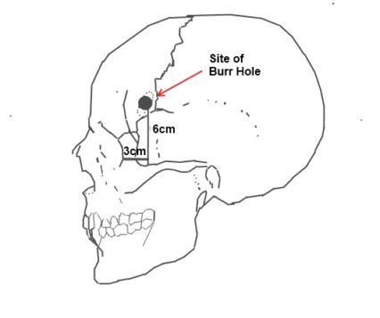 Walter Freeman, who championed lobotomy in the US, was touring with his ...