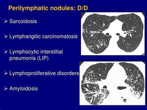 Technical aspect of hrct; normal lung anatomy & hrct findings of lung…