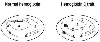 Hemoglobin C Diease and Trait laboratory diagnosis | Medical Laboratories