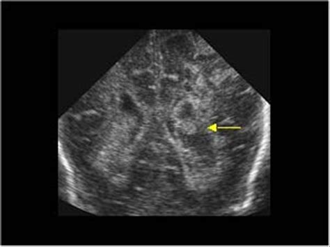 Pediatrics | 9.6 Neonatal brain and spine : Case 9.6.2 Hemorrhage and periventricular cysts ...