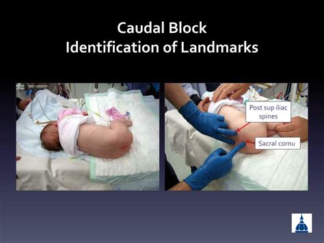 PPT - Kiddie-Caudals Caudal Epidural Analgesia in Everyday Pediatric ...