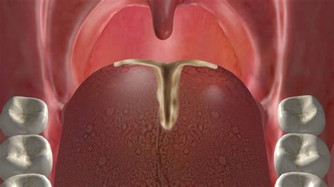 Midline Base of Tongue Partial Glossectomy for Sleep Apnea (OSA) | Sleep apnea, Apnea, Base