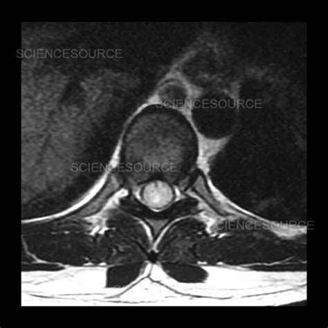 Thoracic Spinal Cord Ependymoma, MRI | Stock Image - Science Source Images