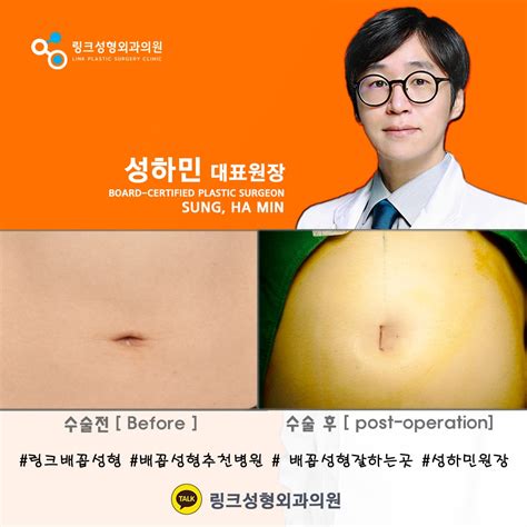 korean plastic surgery | link plastic surgery | BELLY BUTTON RESHAPING SURGERY | belly button ...