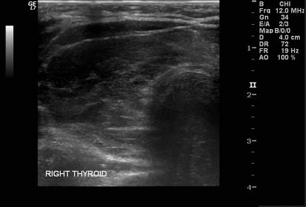 Goiter | Radiology Reference Article | Radiopaedia.org