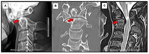 Dens Fracture Ct