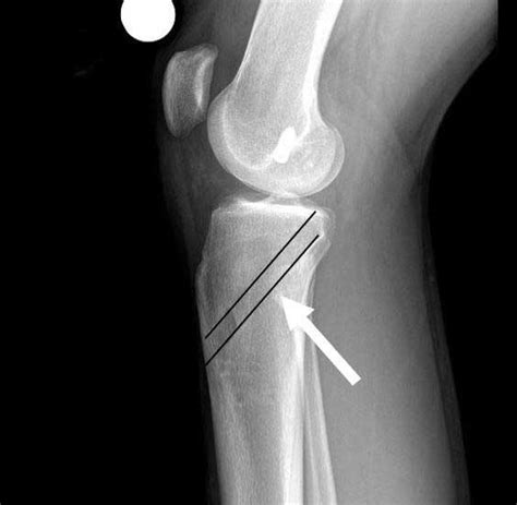 PCL Reconstruction | Posterior Cruciate Ligament Surgery | Minnesota