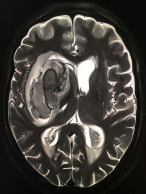 MRI Scan of the Brain