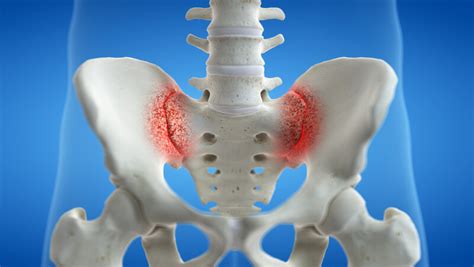 Sacroiliac Joint Pain - Magaziner