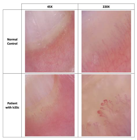 High Magnification Nailfold Capillary Examination for the Diagnosis of Systemic Scleroderma ...