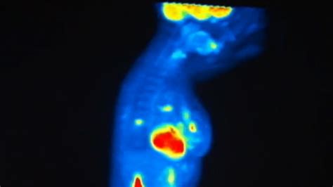 False-Positive Mammogram Result May Point to Higher Risk - NBC News