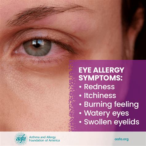 Eye Allergy / Allergic Conjunctivitis