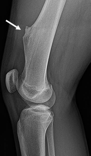 Osteochondroma: Causes, Symptoms and Treatments | HSS (2023)