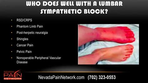 Lumbar Sympathetic Blocks Explained by a Nevada Pain Center (702) 323-0553 - YouTube