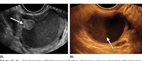 Figure 25 from Findings of pelvic endometriosis at transvaginal US, MR imaging, and laparoscopy ...