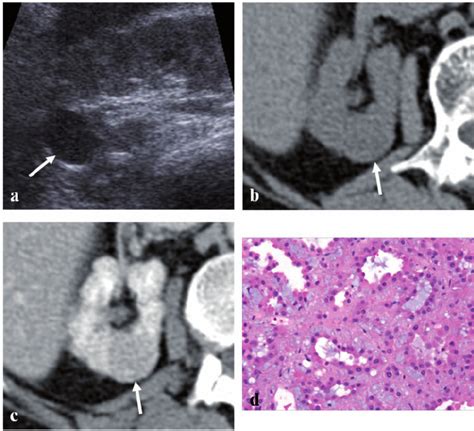 A 65-year-old woman with mucinous tubular and spindle cell carcinoma of ...