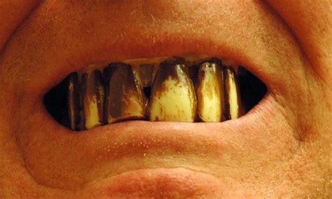 Ugly Teeth | Flickr - Photo Sharing!