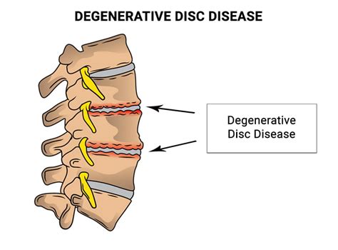 Cervical Degenerative Disc Disease Doctors NJ & NYC