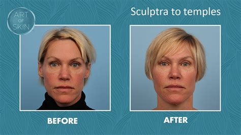 Sculptra injection to temples - YouTube